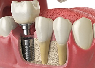 Animated dental implant fused with bone and tissue and the metal abutment and restoration is placed over the top of the implant