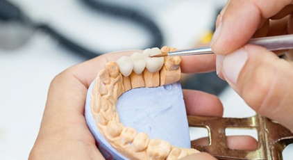 dental bridge in Kernersville