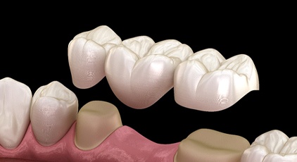 traditional dental bridge in Kernersville