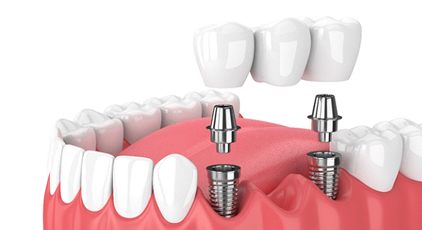 implant denture bridge in Kernersville
