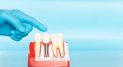 Hand pointing to model of dental implants in Kernersville