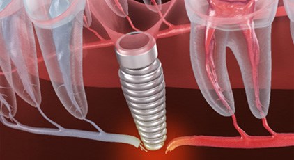 A 3D illustration of a failed dental implant