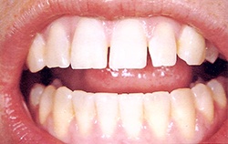 Before porcelain veneers