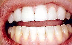 after porcelain veneers