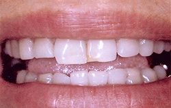 before teeth whitening