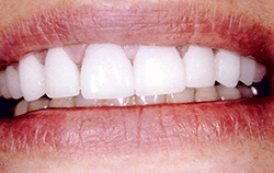 after teeth whitening