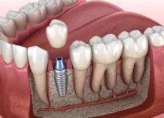 dental implant with a crown replacing a single missing tooth 
