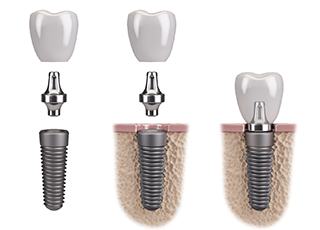 A digital image of a dental implant and all its parts