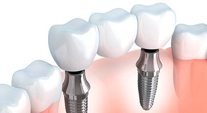 Animated dental bridge placement