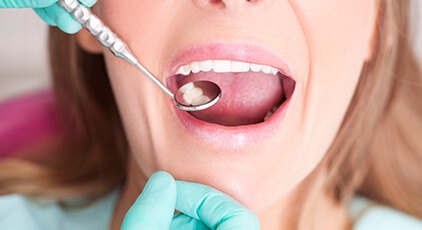 Dentist checking teeth after dental sealants