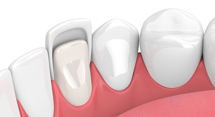 Animated smile during porcelain veneer placement