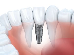 Dental implants in Kernersville are a comprehensive solution to tooth loss. 