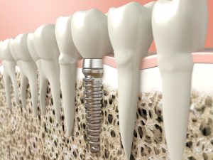 illustration of dental implant