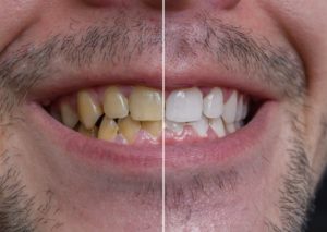 before and after teeth