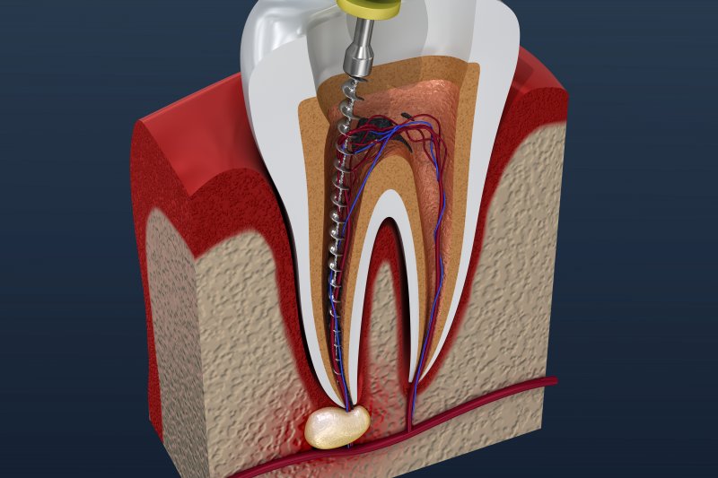 a digital image cross-section of a tooth undergoing a root canal in Kernersville