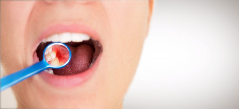 an up-close look at a dental mirror exposing red, swollen gums inside a patient’s mouth