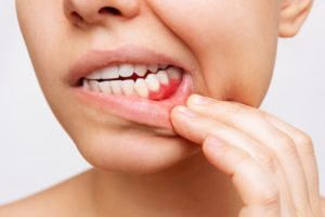 a closeup of a patient’s teeth and gums