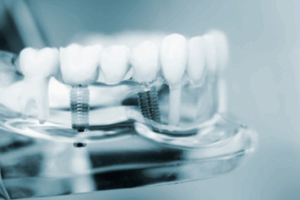 Transparent model of two dental implants on a lower dental arch